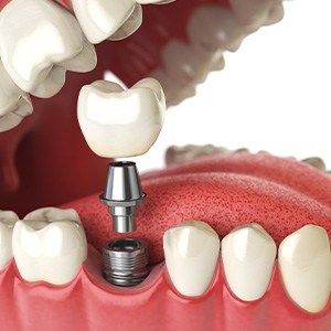 Single dental implant