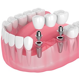 Implant bridge