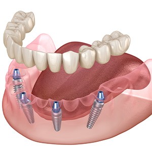 Implant denture