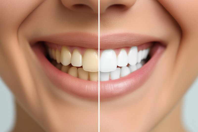 up-close look at before and after teeth whitening results