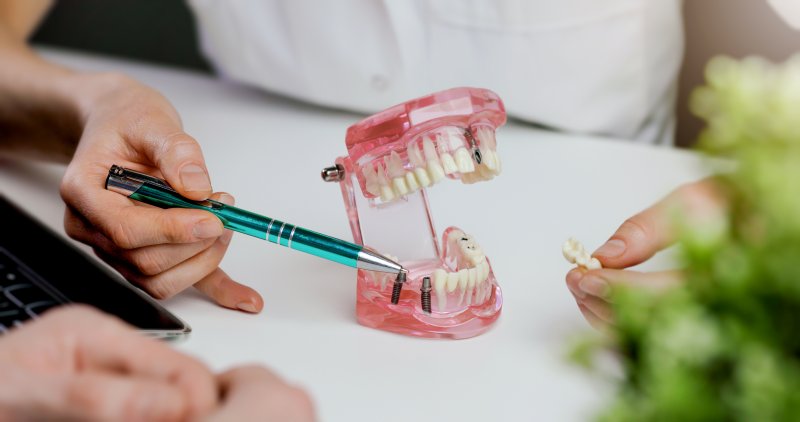 Mouth mold containing dental implants