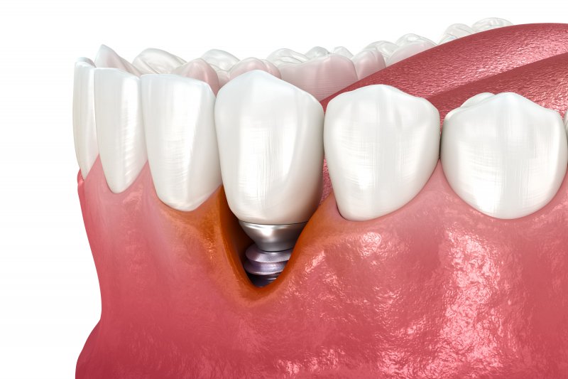 failing dental implant